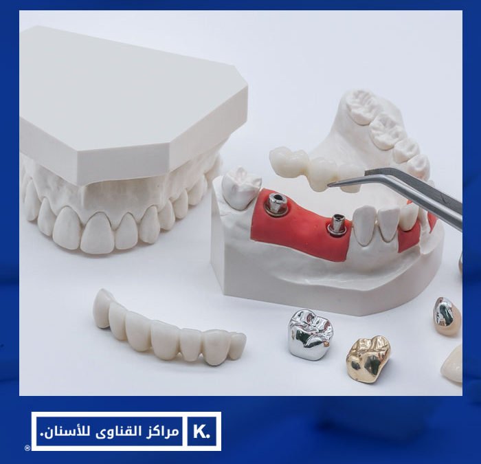 انواع تركيبات الاسنان
