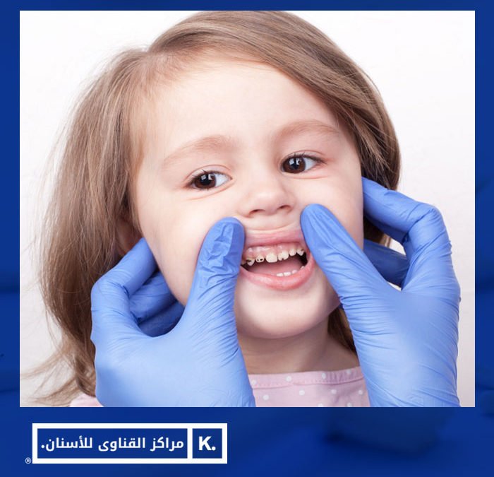 تسوس الاسنان عند الاطفال