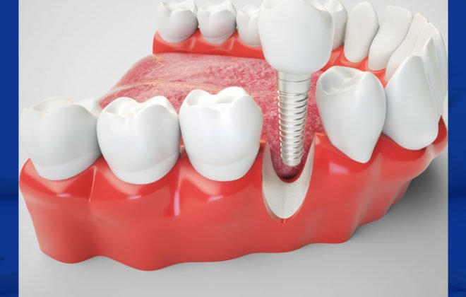 حقيقة زراعة الأسنان الفورية