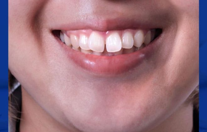 علاج بروز الاسنان الامامية بدون تقويم