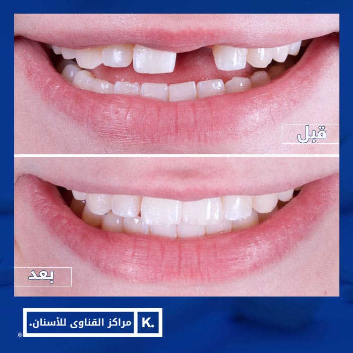 منخفض عملية حسابية زميل  سعر تبييض الاسنان - اسعار تبييض الاسنان بالليزر- الأستاذ الدكتور محمد  القناوي