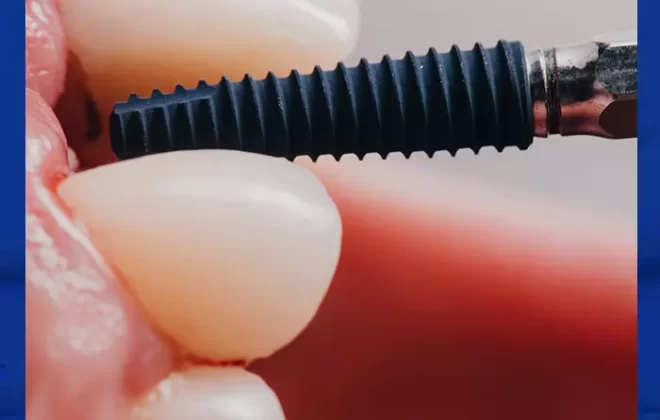عملية زراعة الاسنان